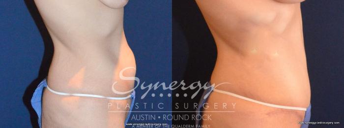 Before & After Abdominoplasty (Tummy Tuck) Case 455 View #4 View in Austin, TX