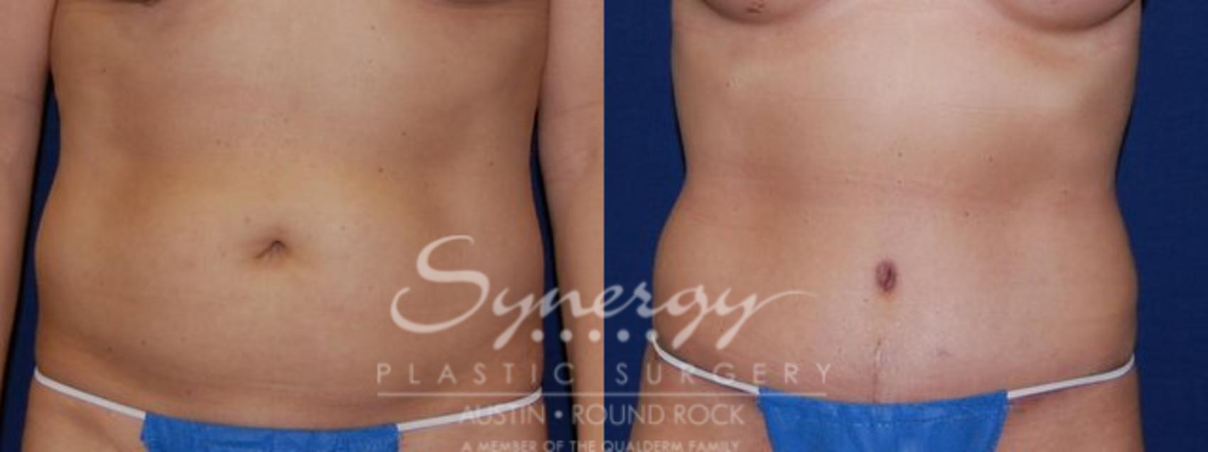 Before & After Abdominoplasty (Tummy Tuck) Case 50 View #1 View in Austin, TX