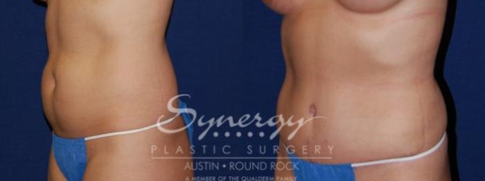 Before & After Abdominoplasty (Tummy Tuck) Case 50 View #2 View in Austin, TX