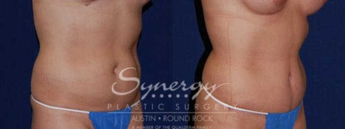 Before & After Abdominoplasty (Tummy Tuck) Case 50 View #3 View in Austin, TX