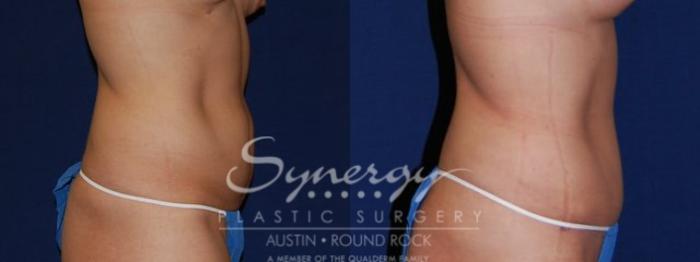 Before & After Abdominoplasty (Tummy Tuck) Case 50 View #4 View in Austin, TX