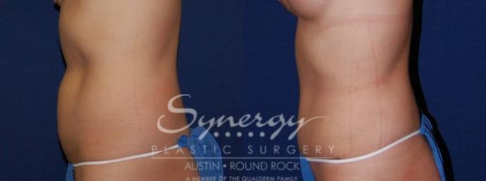 Before & After Abdominoplasty (Tummy Tuck) Case 50 View #5 View in Austin, TX