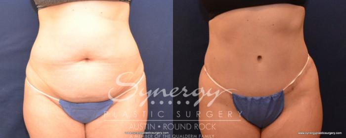 Before & After Abdominoplasty (Tummy Tuck) Case 542 View #1 View in Austin, TX