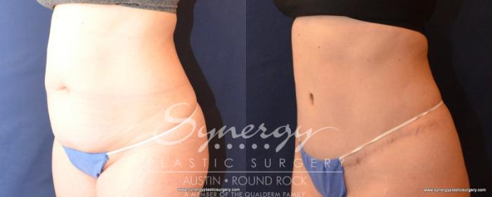 Before & After Abdominoplasty (Tummy Tuck) Case 542 View #2 View in Austin, TX