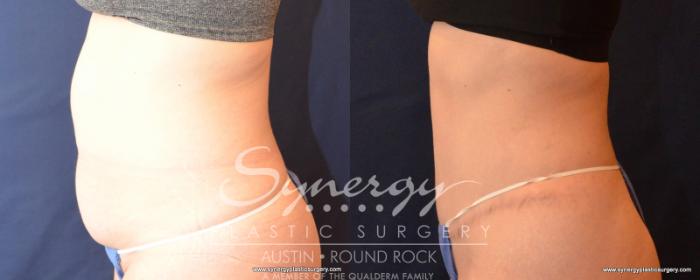 Before & After Abdominoplasty (Tummy Tuck) Case 542 View #3 View in Austin, TX
