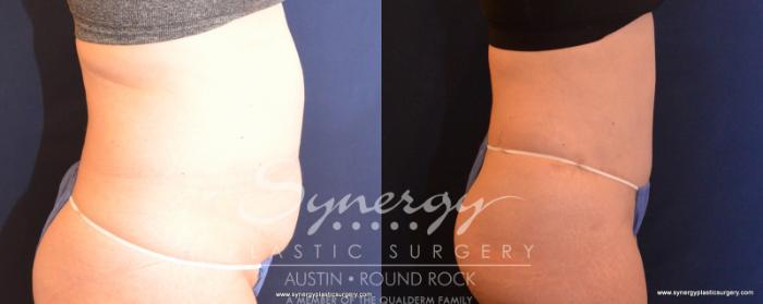 Before & After Abdominoplasty (Tummy Tuck) Case 542 View #4 View in Austin, TX
