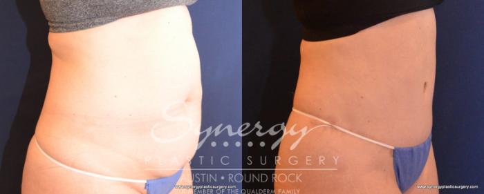 Before & After Abdominoplasty (Tummy Tuck) Case 542 View #5 View in Austin, TX