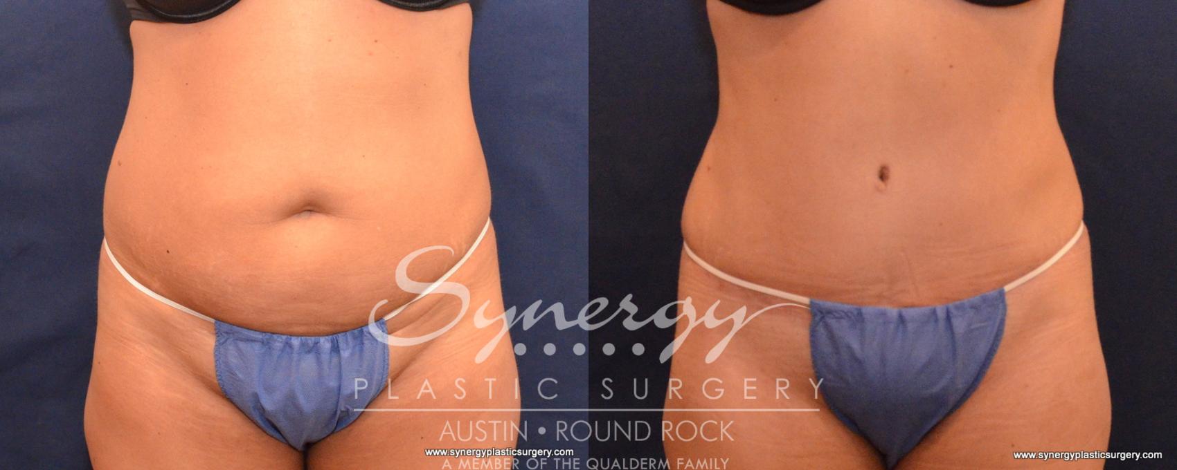 Before & After Abdominoplasty (Tummy Tuck) Case 543 View #1 View in Austin, TX