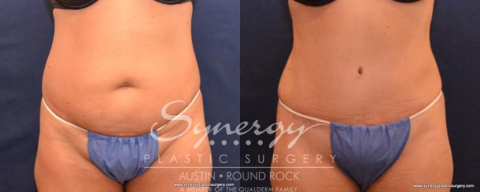 Before & After Abdominoplasty (Tummy Tuck) Case 543 View #1 View in Austin, TX