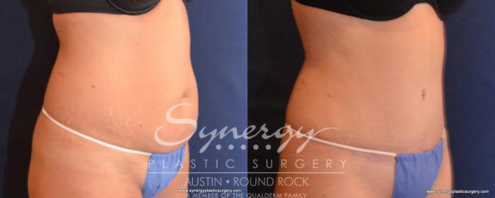 Before & After Abdominoplasty (Tummy Tuck) Case 543 View #2 View in Austin, TX