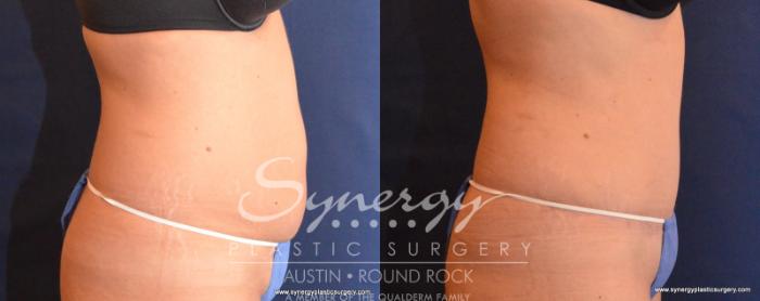 Before & After Abdominoplasty (Tummy Tuck) Case 543 View #3 View in Austin, TX