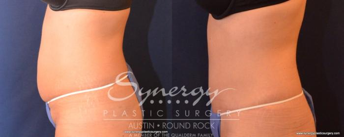 Before & After Abdominoplasty (Tummy Tuck) Case 543 View #4 View in Austin, TX