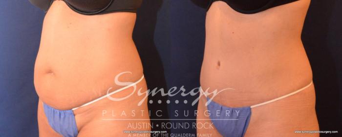 Before & After Abdominoplasty (Tummy Tuck) Case 543 View #5 View in Austin, TX