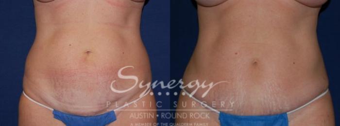 Before & After Abdominoplasty (Tummy Tuck) Case 55 View #1 View in Austin, TX