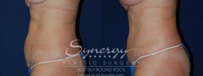Before & After Abdominoplasty (Tummy Tuck) Case 55 View #2 View in Austin, TX