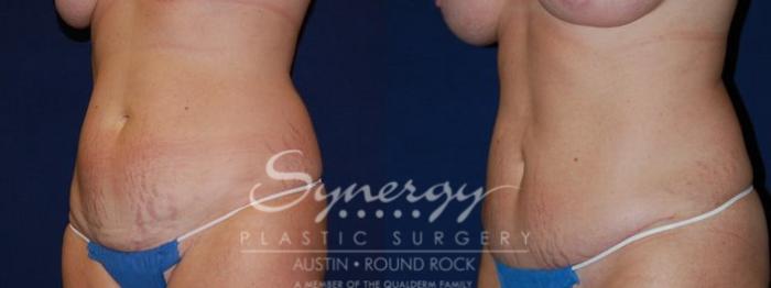 Before & After Abdominoplasty (Tummy Tuck) Case 55 View #3 View in Austin, TX