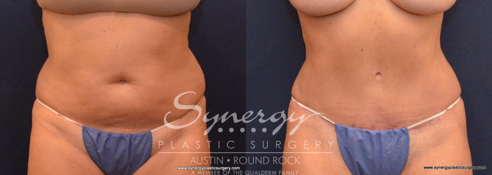 Before & After Abdominoplasty (Tummy Tuck) Case 576 View #1 View in Austin, TX