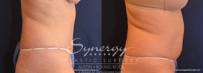 Before & After Abdominoplasty (Tummy Tuck) Case 576 View #2 View in Austin, TX
