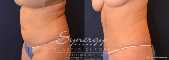 Before & After Abdominoplasty (Tummy Tuck) Case 576 View #3 View in Austin, TX