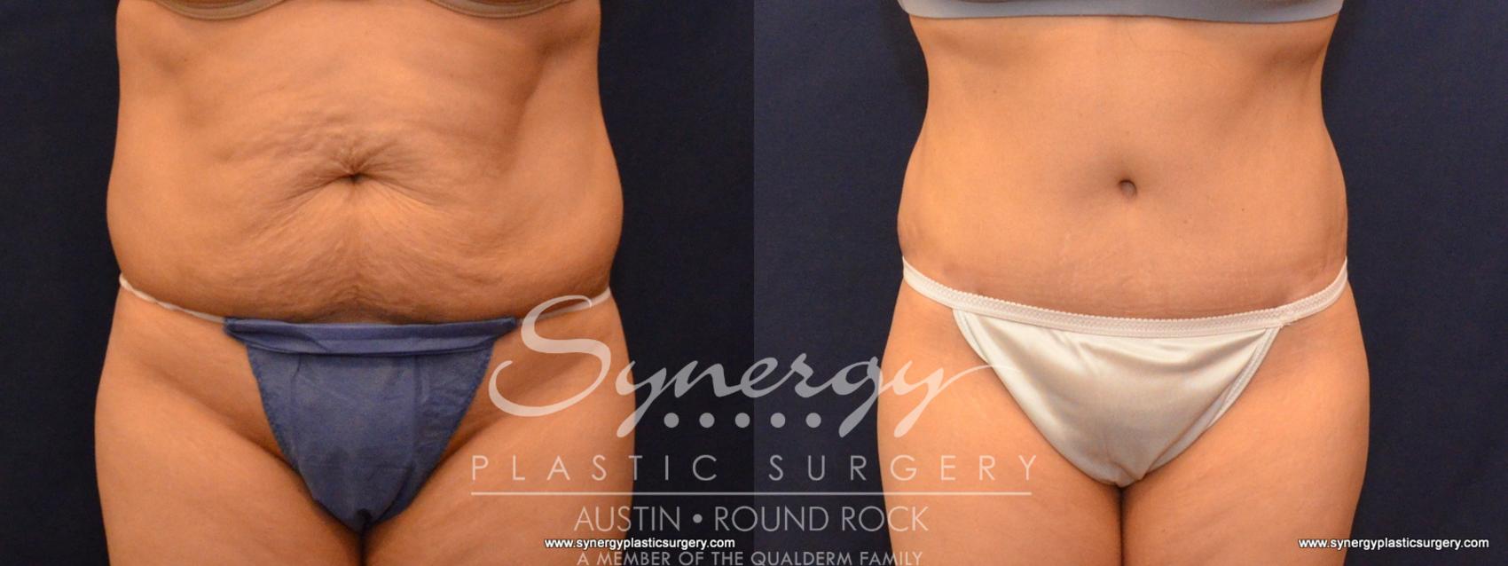 Before & After Abdominoplasty (Tummy Tuck) Case 583 View #1 View in Austin, TX