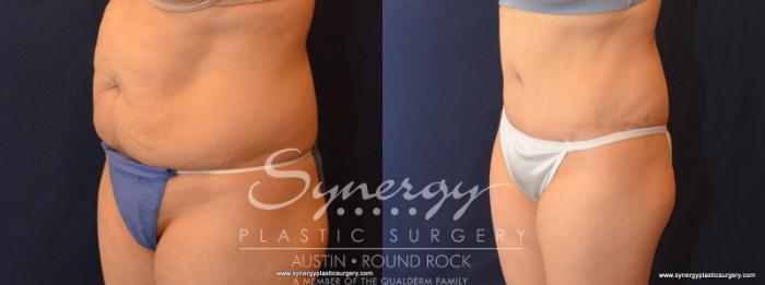 Before & After Abdominoplasty (Tummy Tuck) Case 583 View #2 View in Austin, TX
