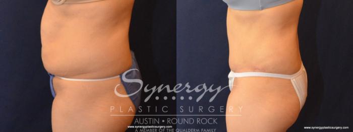 Before & After Abdominoplasty (Tummy Tuck) Case 583 View #3 View in Austin, TX