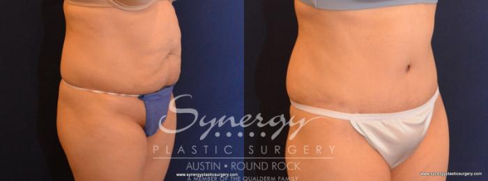 Before & After Abdominoplasty (Tummy Tuck) Case 583 View #4 View in Austin, TX