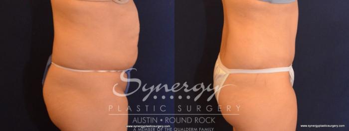 Before & After Abdominoplasty (Tummy Tuck) Case 583 View #5 View in Austin, TX