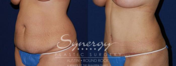 Before & After Abdominoplasty (Tummy Tuck) Case 59 View #1 View in Austin, TX