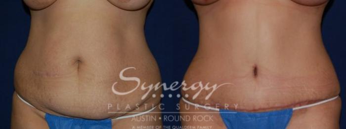 Before & After Abdominoplasty (Tummy Tuck) Case 59 View #2 View in Austin, TX