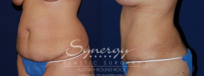 Before & After Abdominoplasty (Tummy Tuck) Case 59 View #4 View in Austin, TX