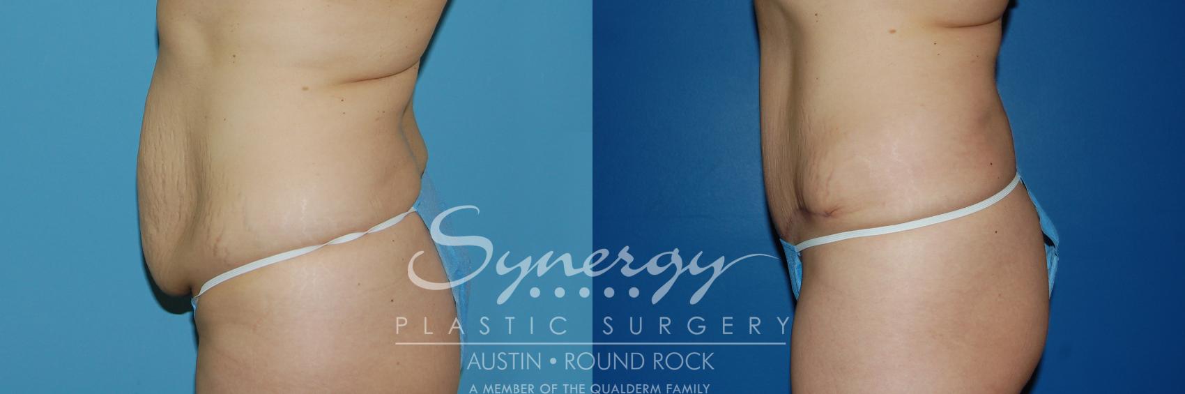 Before & After Abdominoplasty (Tummy Tuck) Case 6 View #1 View in Austin, TX
