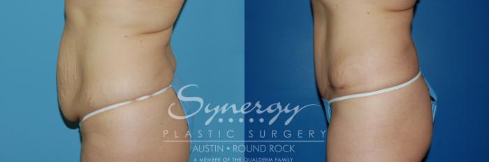 Before & After Abdominoplasty (Tummy Tuck) Case 6 View #1 View in Austin, TX