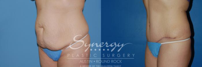 Before & After Abdominoplasty (Tummy Tuck) Case 6 View #2 View in Austin, TX