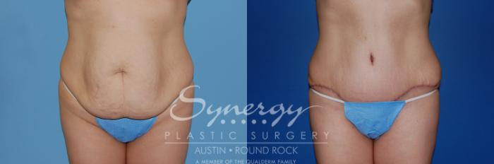 Before & After Abdominoplasty (Tummy Tuck) Case 6 View #3 View in Austin, TX