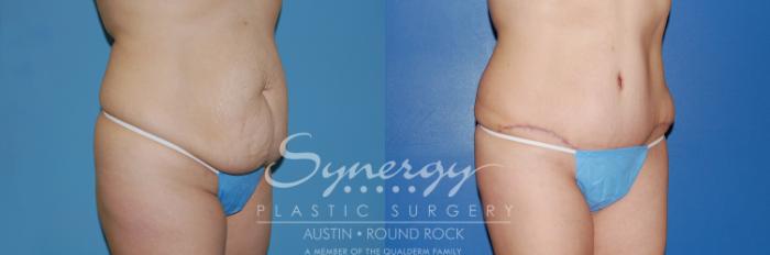 Before & After Abdominoplasty (Tummy Tuck) Case 6 View #4 View in Austin, TX