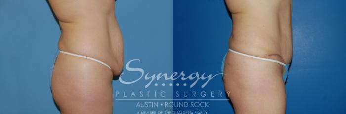 Before & After Abdominoplasty (Tummy Tuck) Case 6 View #5 View in Austin, TX