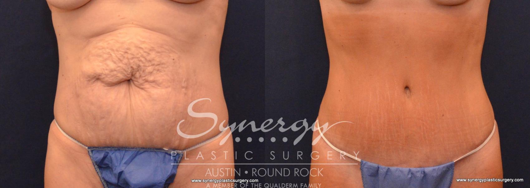 Before & After Abdominoplasty (Tummy Tuck) Case 607 View #1 View in Austin, TX