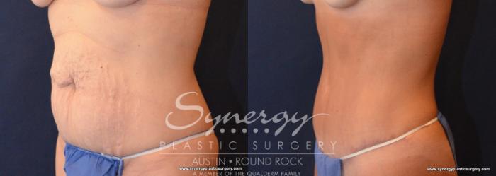 Before & After Abdominoplasty (Tummy Tuck) Case 607 View #2 View in Austin, TX