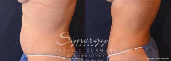 Before & After Abdominoplasty (Tummy Tuck) Case 607 View #3 View in Austin, TX