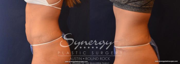 Before & After Abdominoplasty (Tummy Tuck) Case 617 View #2 View in Austin, TX