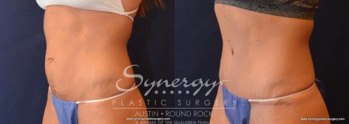 Before & After Abdominoplasty (Tummy Tuck) Case 617 View #3 View in Austin, TX