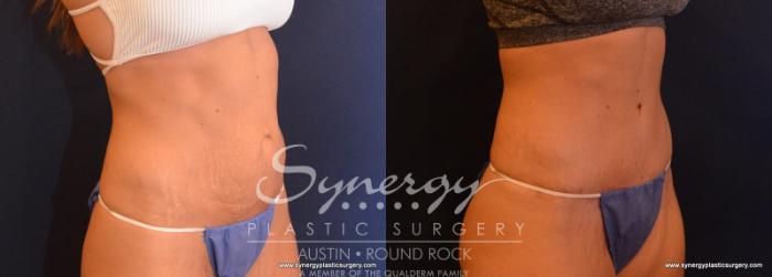 Before & After Abdominoplasty (Tummy Tuck) Case 617 View #4 View in Austin, TX