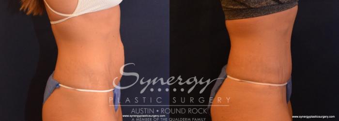 Before & After Abdominoplasty (Tummy Tuck) Case 617 View #5 View in Austin, TX