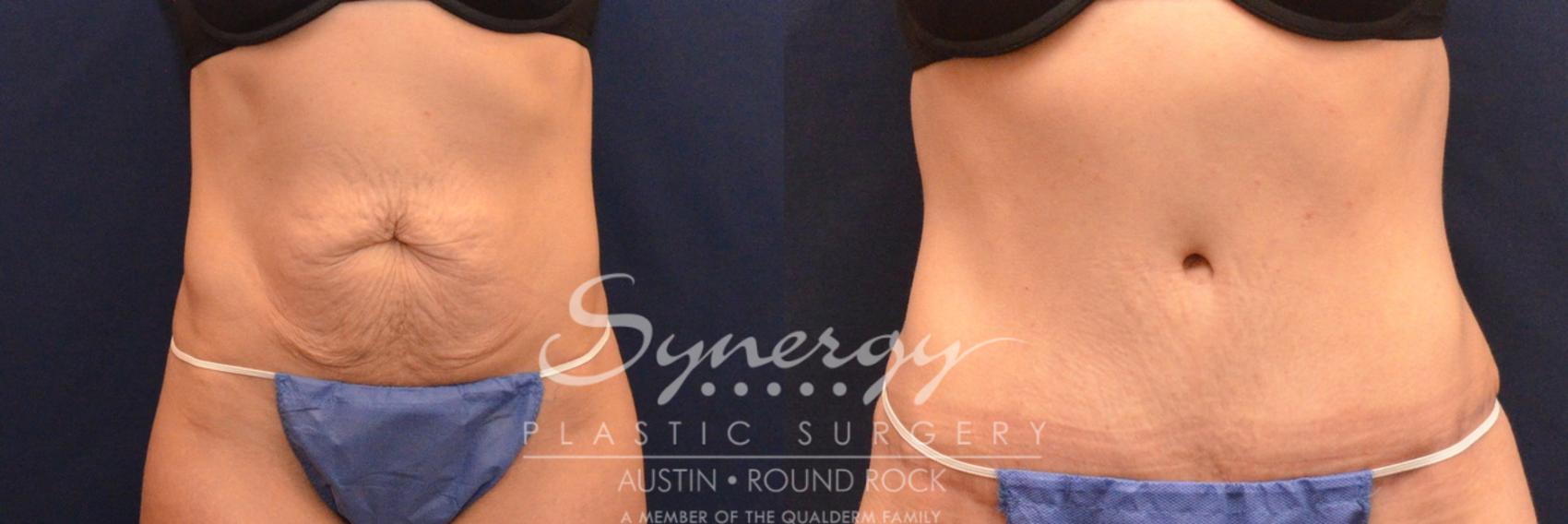 Before & After Abdominoplasty (Tummy Tuck) Case 627 View #1 View in Austin, TX