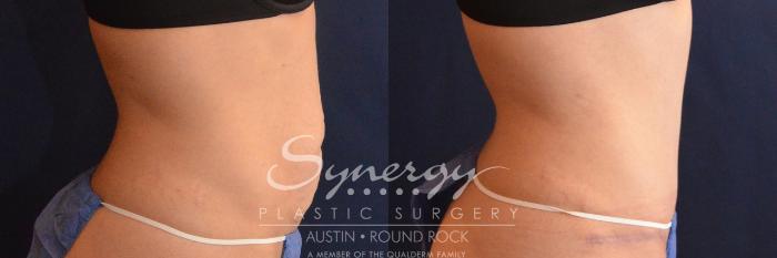 Before & After Abdominoplasty (Tummy Tuck) Case 627 View #2 View in Austin, TX