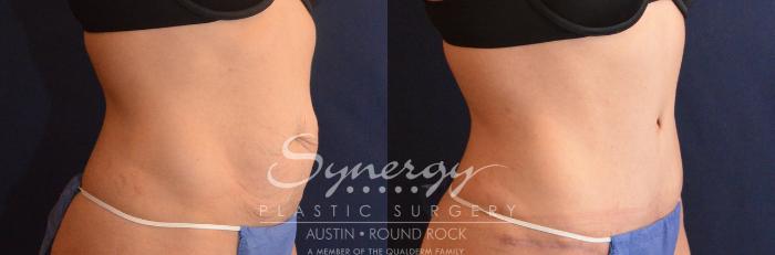 Before & After Abdominoplasty (Tummy Tuck) Case 627 View #3 View in Austin, TX