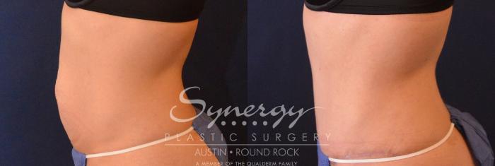 Before & After Abdominoplasty (Tummy Tuck) Case 627 View #4 View in Austin, TX
