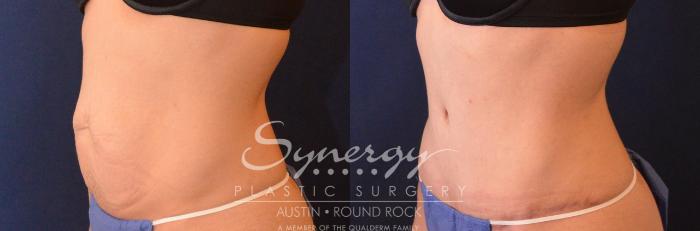 Before & After Abdominoplasty (Tummy Tuck) Case 627 View #5 View in Austin, TX