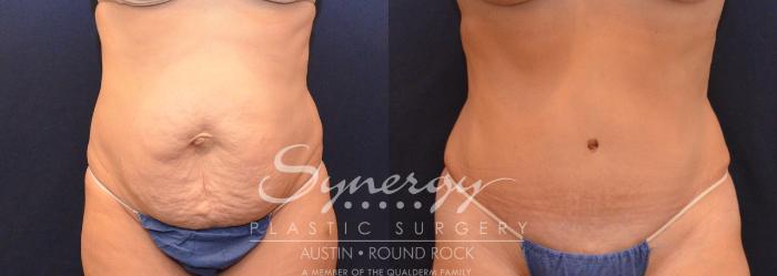 Before & After Abdominoplasty (Tummy Tuck) Case 630 View #1 View in Austin, TX